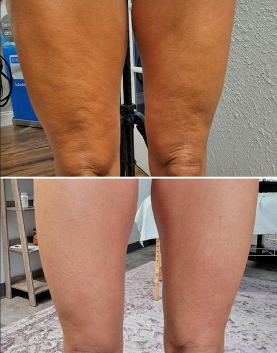 The these photos show before (top) and after (bottom) skin tightening and toning treatment.
